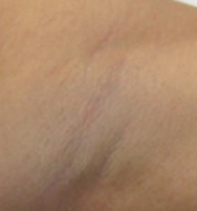 After — Hair removal