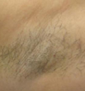 Before — Hair removal