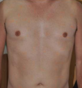 After — Hair removal