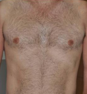 Before — Hair removal