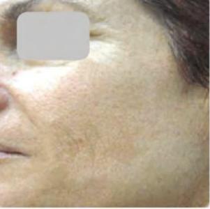 After — Pigmented lesions