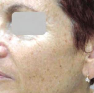 Before — Pigmented lesions