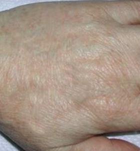 After — Pigmented lesions