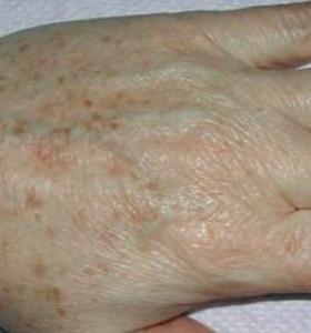Before — Pigmented lesions