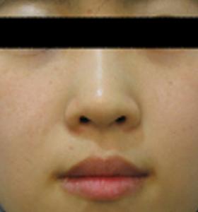 After — Pigmented lesions