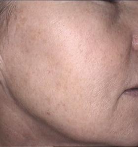 After — Pigmented lesions