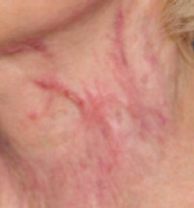 Before — Skin Resurfacing