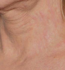 After — Skin Resurfacing