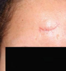 Before — Skin resurfacing