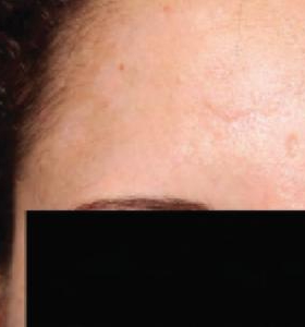 After — Skin resurfacing