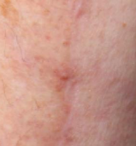 Before — Stretch marks