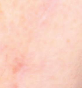 After — Stretch marks