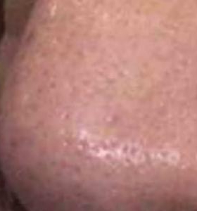 After — Photo facial