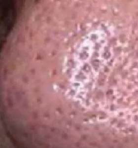 Before — Skin rejuvenation