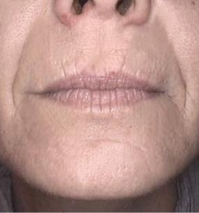 After — Photo facial