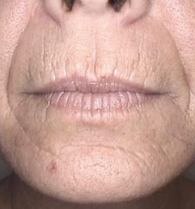 Before — Photo facial
