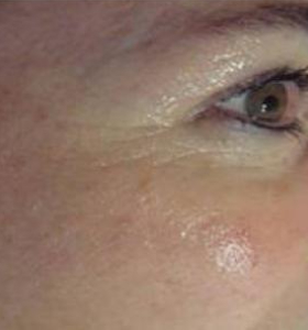 After — Photo facial