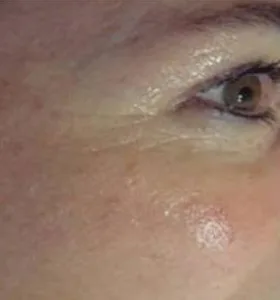 After — Skin rejuvenation