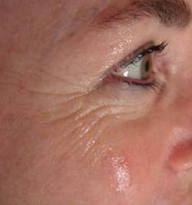 Before — Photo facial