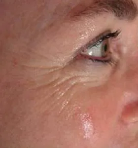 Before — Skin rejuvenation