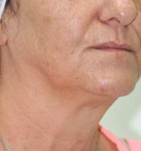 After — Photo facial