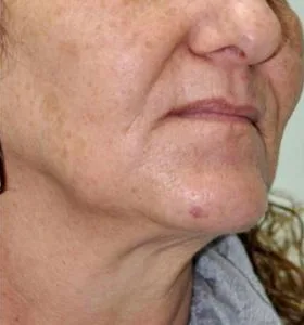 Before — Skin rejuvenation