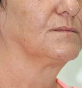 After — Photo facial