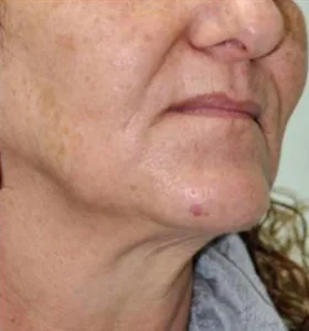 Before — Photo facial