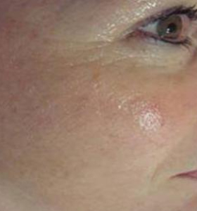 After — Raffermissement facial