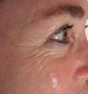 Before — Raffermissement facial