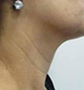 Before — Skin tightening