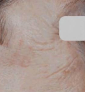 After — Skin tightening