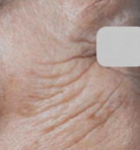 Before — Skin tightening