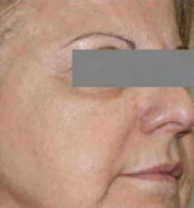 After — Skin tightening