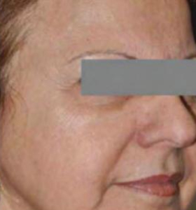 Before — Skin tightening