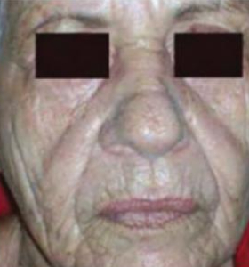 After — Skin tightening