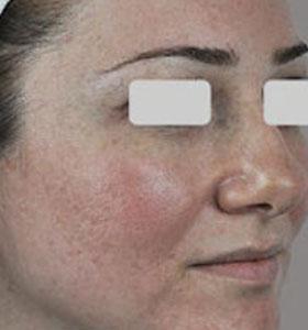 Before — Lésions vasculaires