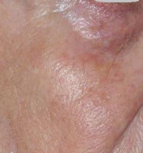 After — Vascular lesions