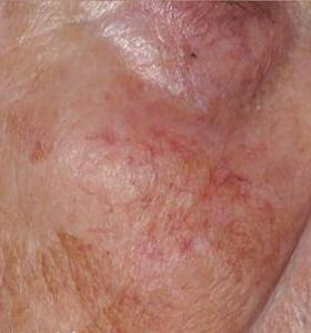 Before — Vascular lesions