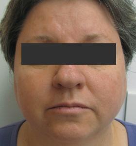 After — Vascular lesions