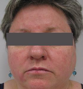 Before — Vascular lesions