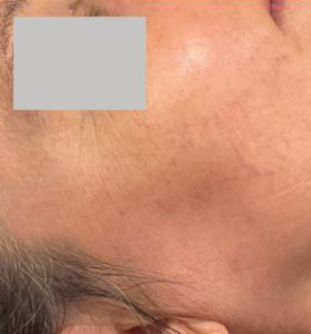 After — Vascular lesions