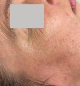 Before — Vascular lesions