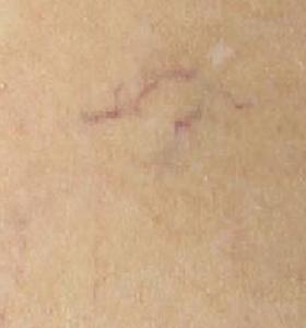 Before — Vein Removal