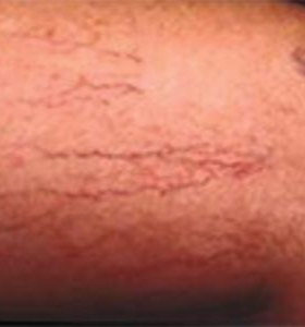 Before — Vein removal