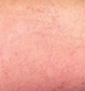 After — Vein removal