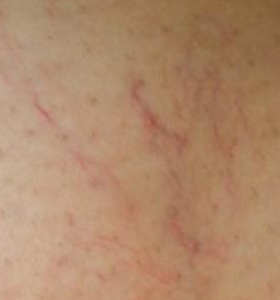 After — Vein removal