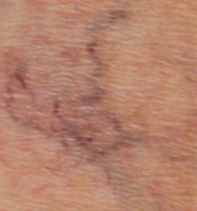 Before — Vein removal