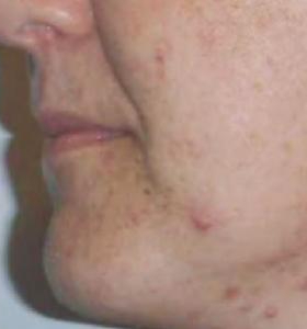 Before — Carbon facial