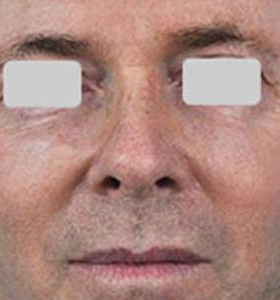 Before — Skin resurfacing